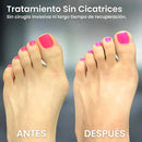 🔥 PROMO 2X1 CORRECTOR DE JUANETES - RESULTADOS EN UN MÊS 🦴